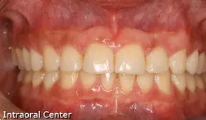 Close-up of a person's upper and lower teeth showing healthy gums and straight teeth, highlighting the expert care you can expect from the braces Kingwood specialists.