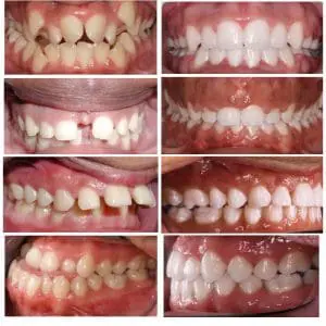 Comparison of dental conditions: three images on the left show misaligned teeth before treatment, and three on the right reveal improved alignment after treatment, from frontal and side views. Discover quality care with braces in Kingwood, TX.