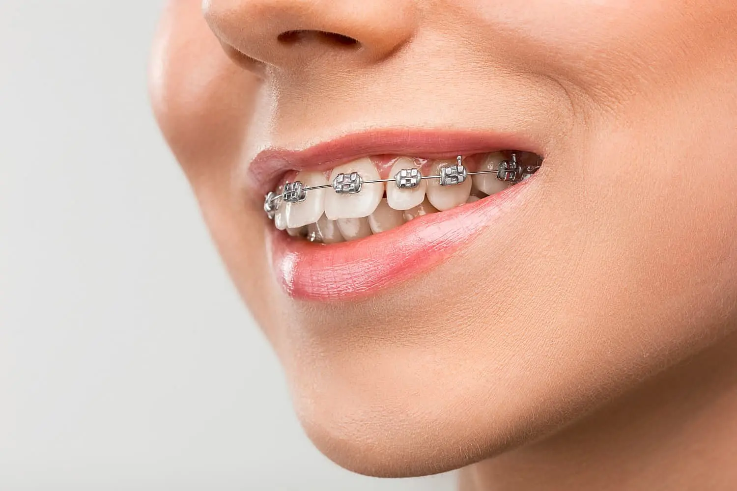 A close-up of someone smiling with metal braces for solution overbite in Kingwood TX at Paige orthodontics