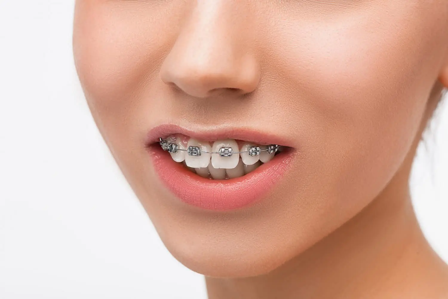 Progress photo of a woman undergoing orthodontic treatment for overbite correction in Kingwood TX at Paige orthodontics