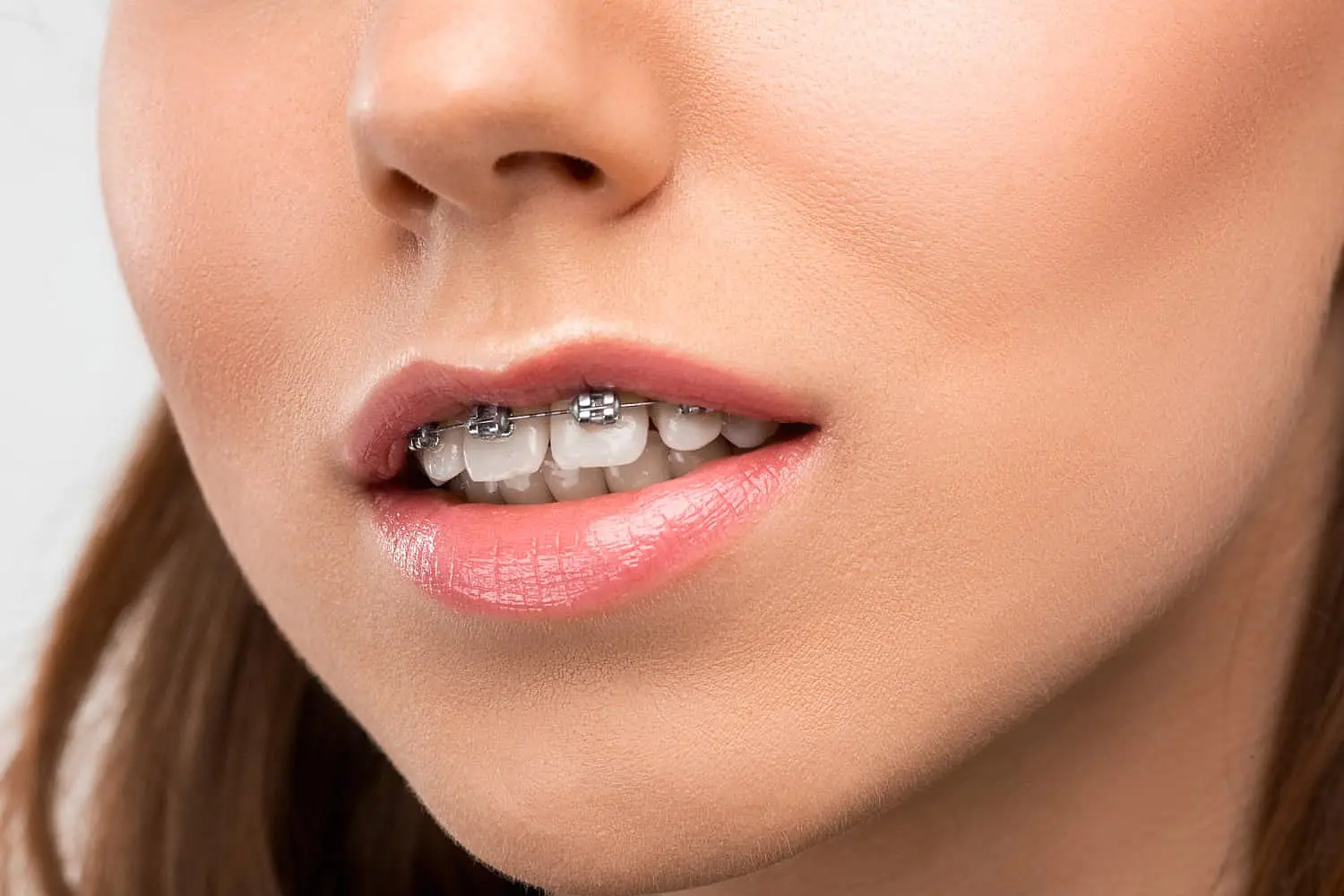 Young woman receiving expert orthodontic care for her overbite in Kingwood TX at Paige orthodontics