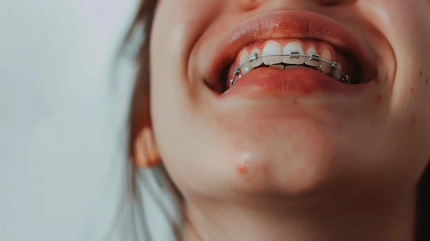 A close-up in Kingwood TX shows a person smiling with metal braces correcting an overbite, with visible skin imperfections on the chin in Kingwood, TX