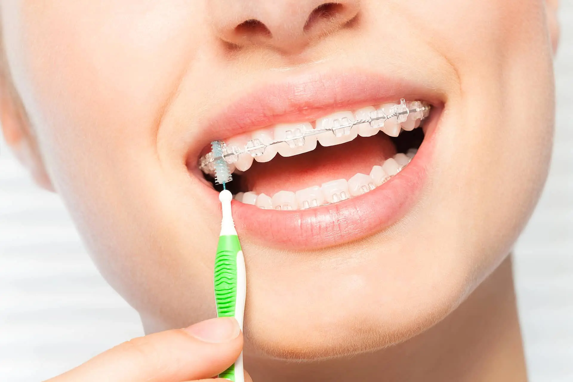 a person uses a small interproximal brush to clean braces with clear brackets at Paige Orthodontics in Kingwood, TX