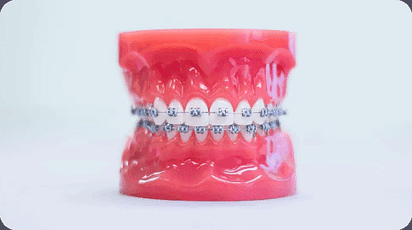 Metal braces straightening teeth effectively during an orthodontic treatment journey at Paige Orthodontics in Kingwood, TX