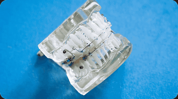 Component of metal braces at Paige Orthodontics in Kingwood, TX