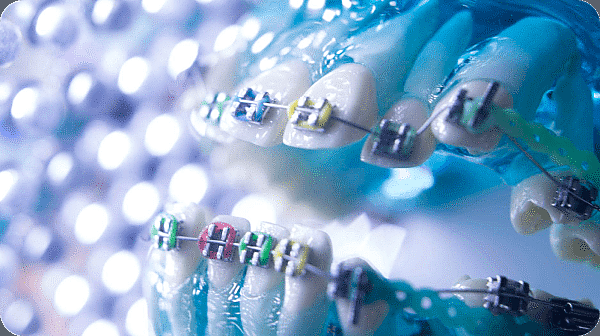 Colorful world of elastic ties of metal braces at Paige Orthodontics in Kingwood, TX