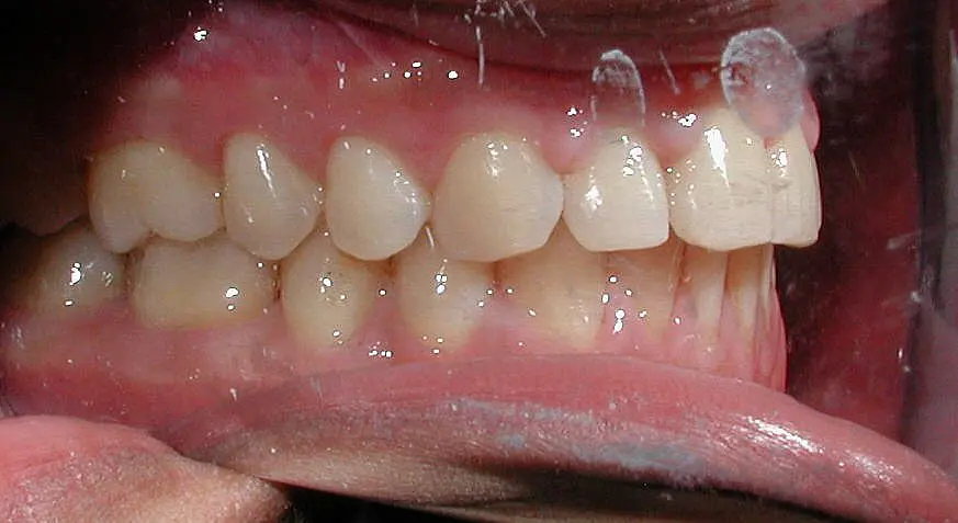 A close-up in Kingwood TX shows an open mouth with teeth and gums visible after braces, displaying both top and bottom rows alongside the tongue.