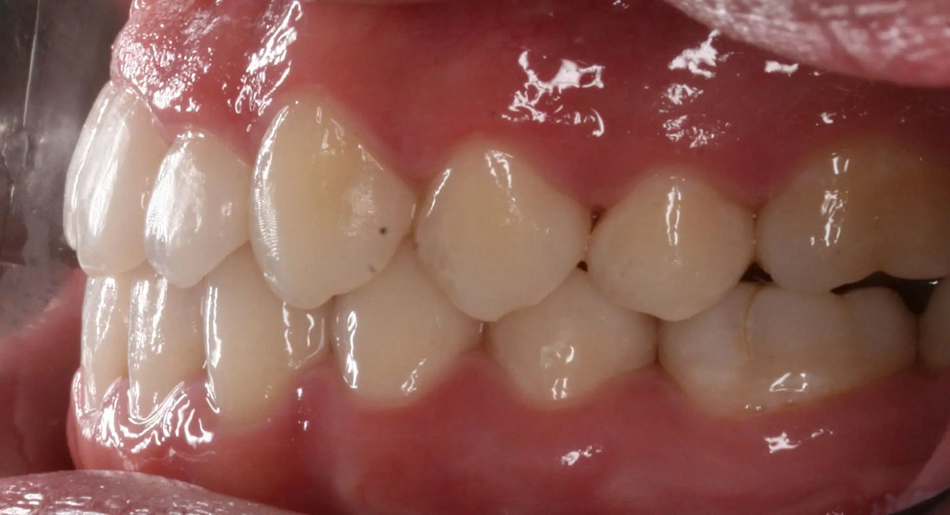 The bright lighting highlights a person's aligned bite and clean white teeth in Kingwood, TX, showcasing impressive results after braces.