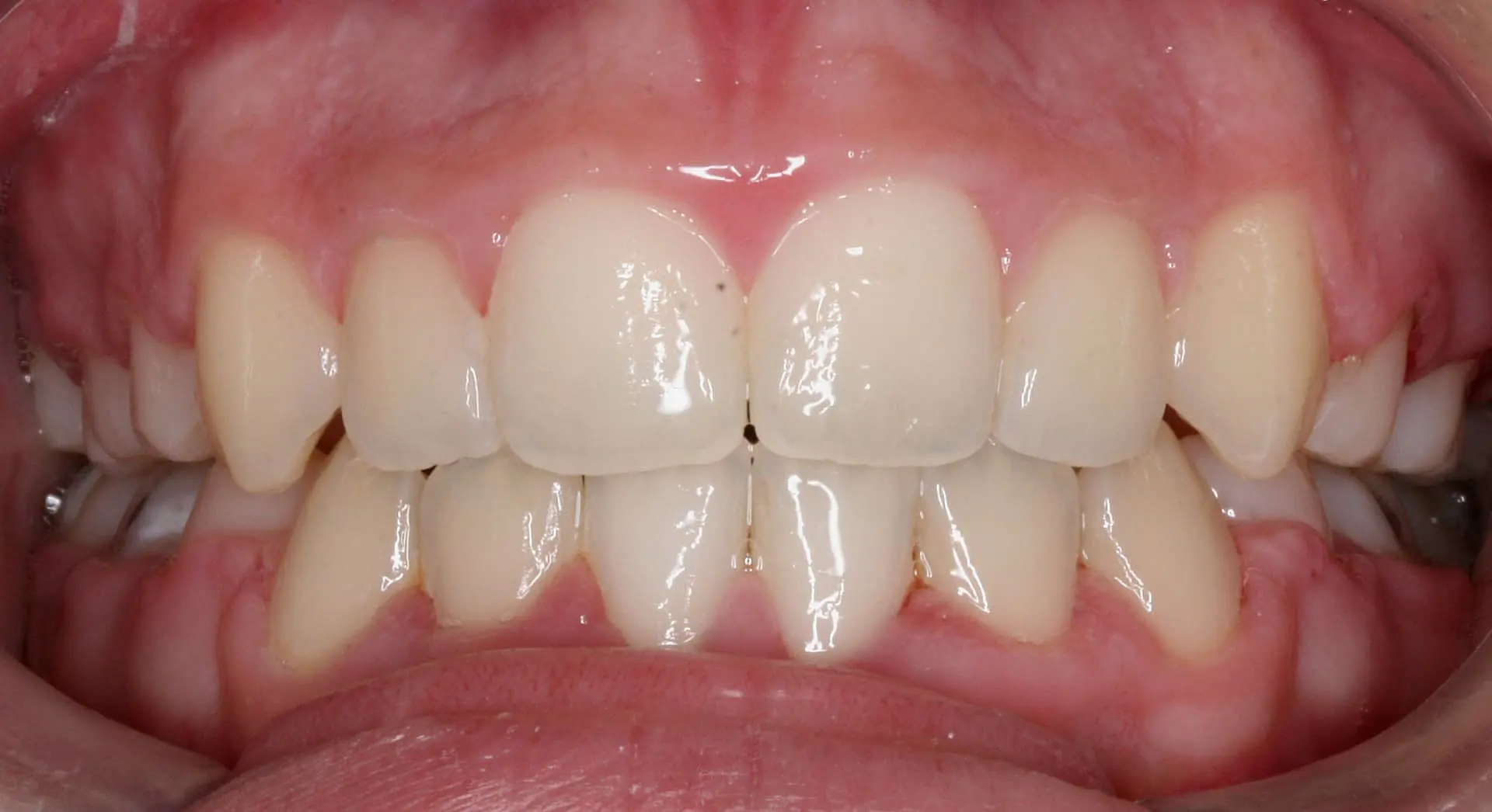A close-up of a person's mouth in Kingwood TX showcases beautifully aligned teeth with a charming gap between the two upper front ones after Invisalign.