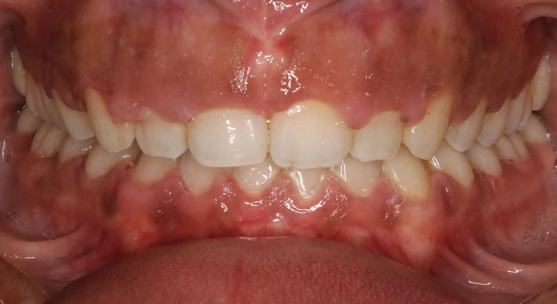 A close-up of a person's teeth in Kingwood TX shows the aligned upper and lower jaws after Invisalign treatment, with slight crowding visible. The healthy pink gum tissue is evident as the lips are pulled back to reveal the transformation.