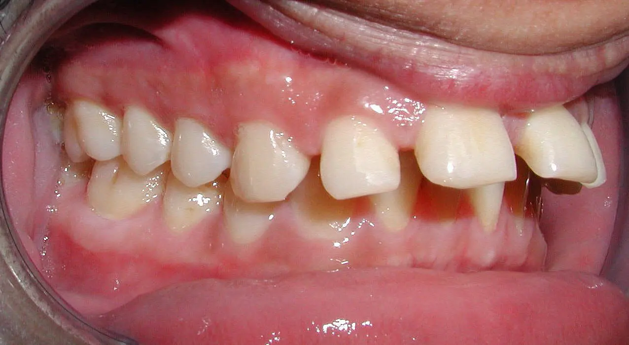 A close-up in Kingwood TX highlights a mouth with protruding upper front teeth, overlapping lower teeth, and visible gums before braces.