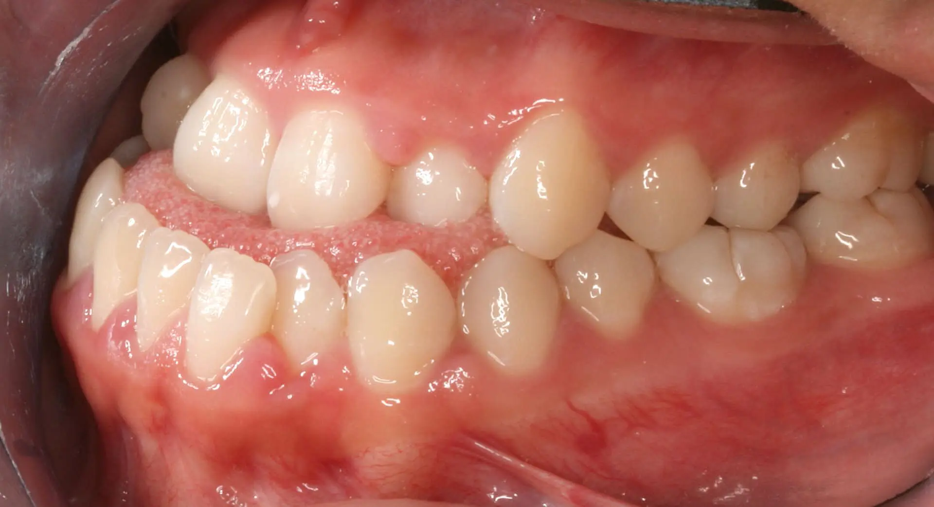 A close-up in Kingwood TX displays a crossbite with misaligned upper and lower teeth before braces treatment, also revealing the gums and inner cheek.
