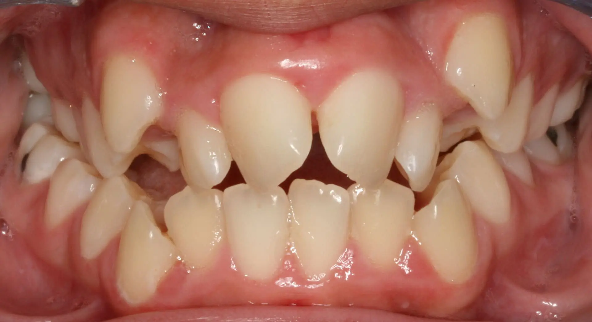 The close-up image from Kingwood TX shows misaligned, crowded teeth with gaps before Invisalign treatment.