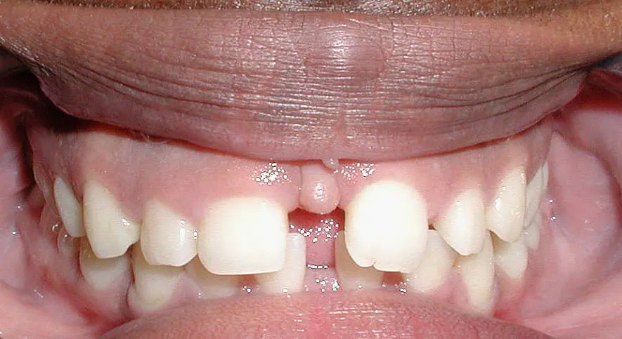 A close-up image highlights the dental challenges before Invisalign treatment, showing a gap between the front upper teeth and a small tissue flap in Kingwood TX.