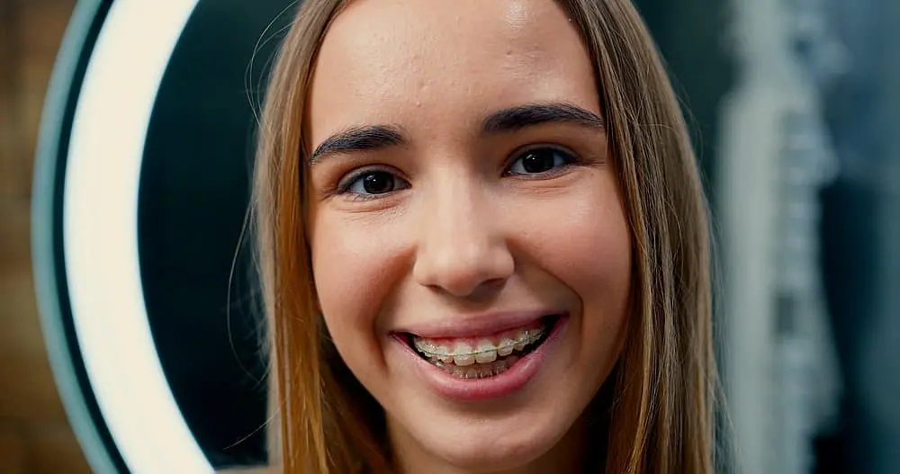 Best Orthodontics Clear braces aligning teeth seamlessly during an orthodontic treatment journey in Kingwood, TX