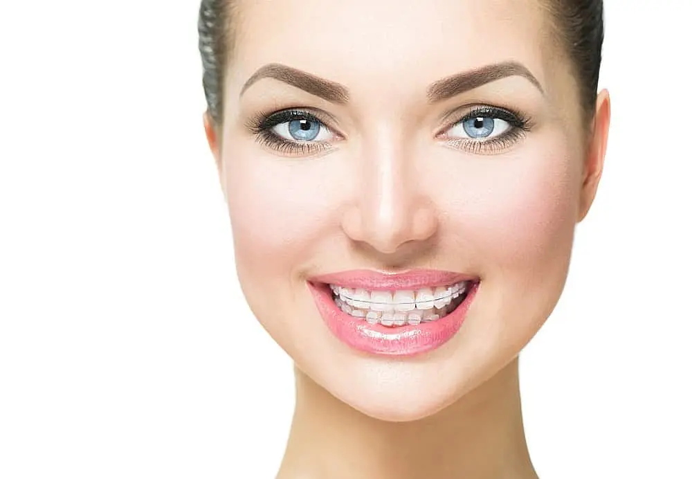 Close-up of a person with clear braces smiling in Kingwood TX.