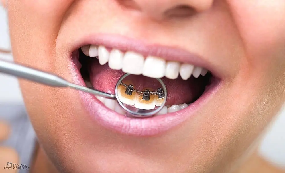 The image shows a close-up of lingual braces as one of the alternatives to braces in Kingwood, TX on the inside of someone's teeth, using a dental mirror, in Kingwood TX.